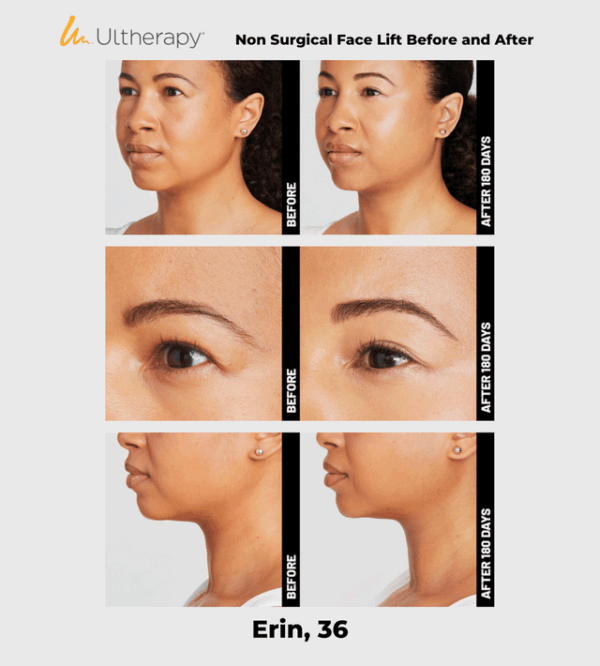 Ulthera Ultherapy DeepSee Transducer DS 10-1.5 (Orange)