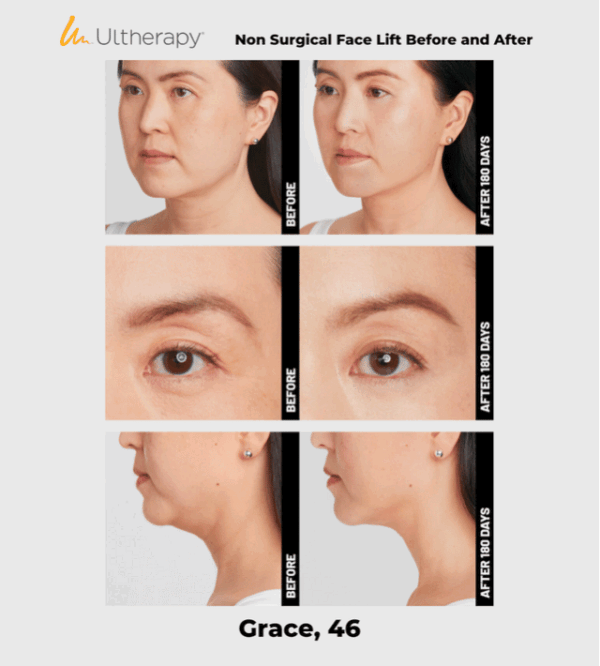 Ulthera Ultherapy DeepSee Transducer DS 10-1.5 (Orange)