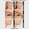 Ulthera Ultherapy DeepSee Transducer DS 10-1.5 (Orange)