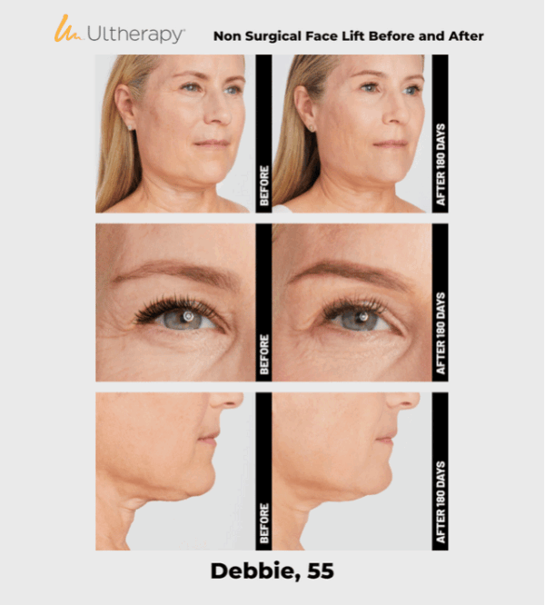 Ulthera Ultherapy DeepSee Transducer DS 10-1.5 (Orange)